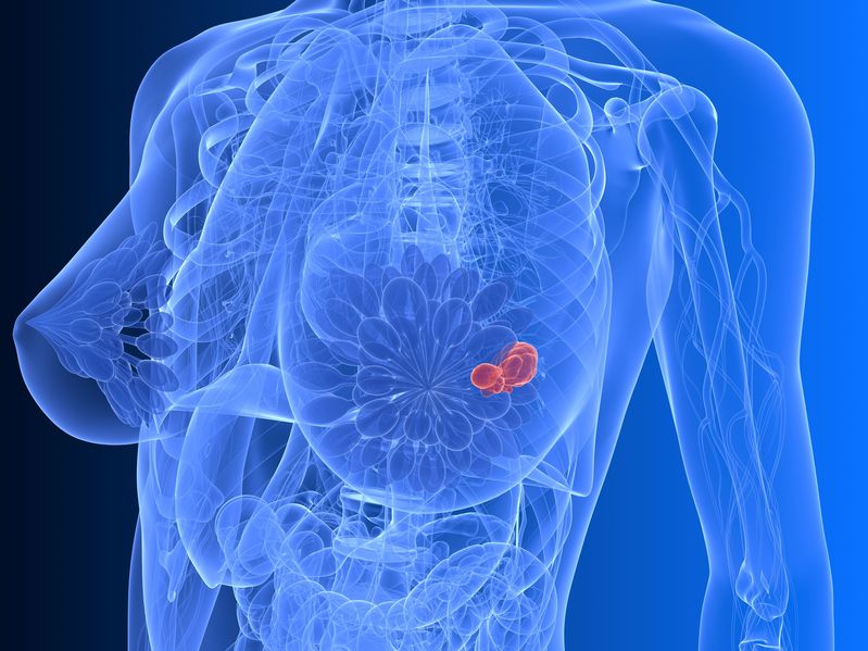 Skríning rakoviny prsníka